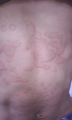 Urticaria In Helminthiasis